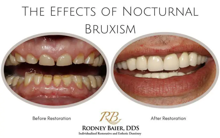 The effects of nocturnal bruxism