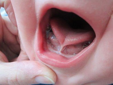 Child with a tongue tie