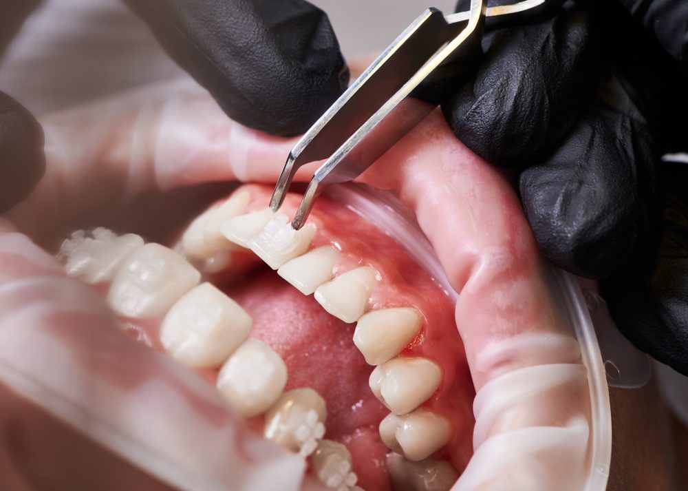 Cracked tooth causes dental exam